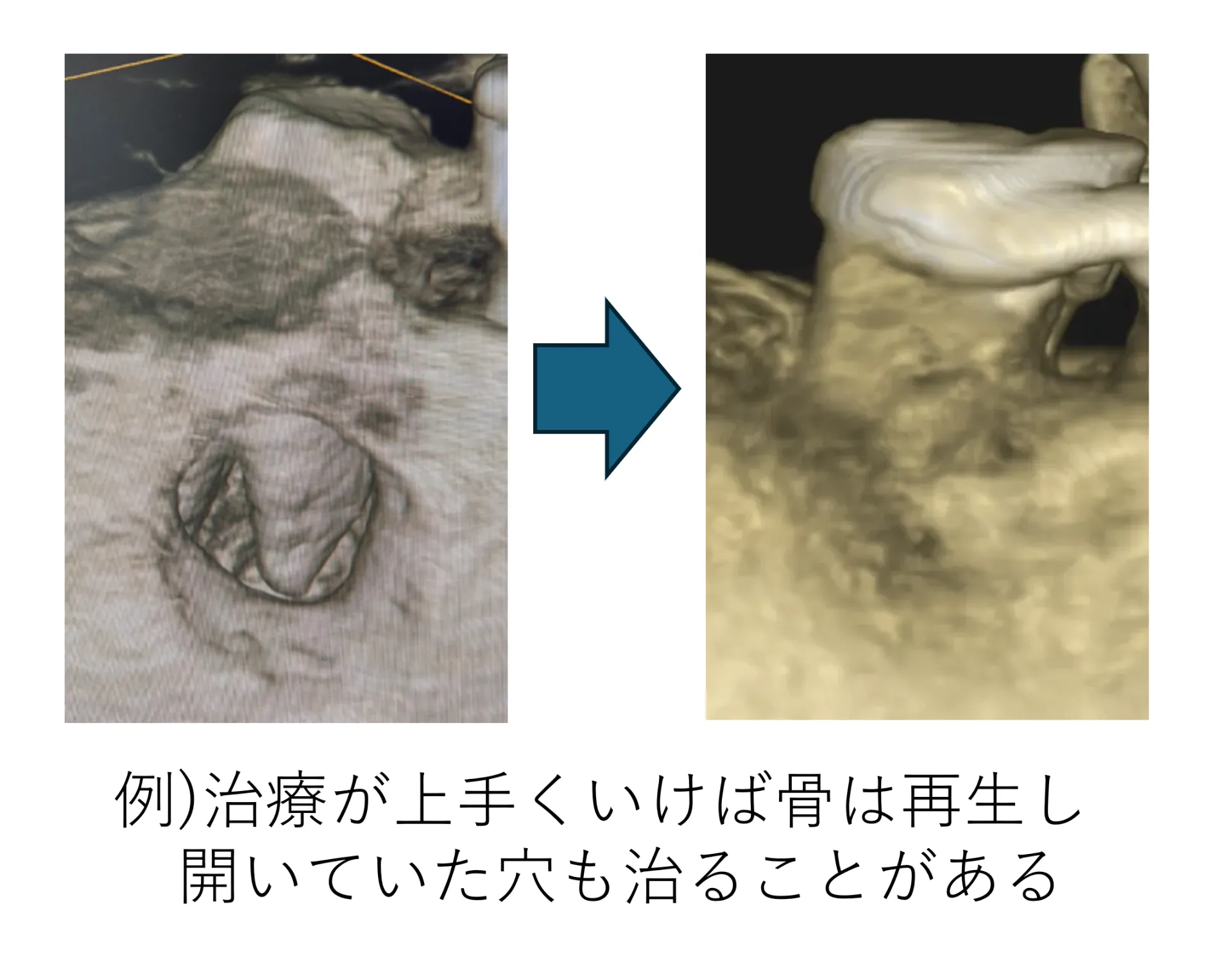 治療がうまくいけば骨は再生し、開いていた穴も治ることがある例