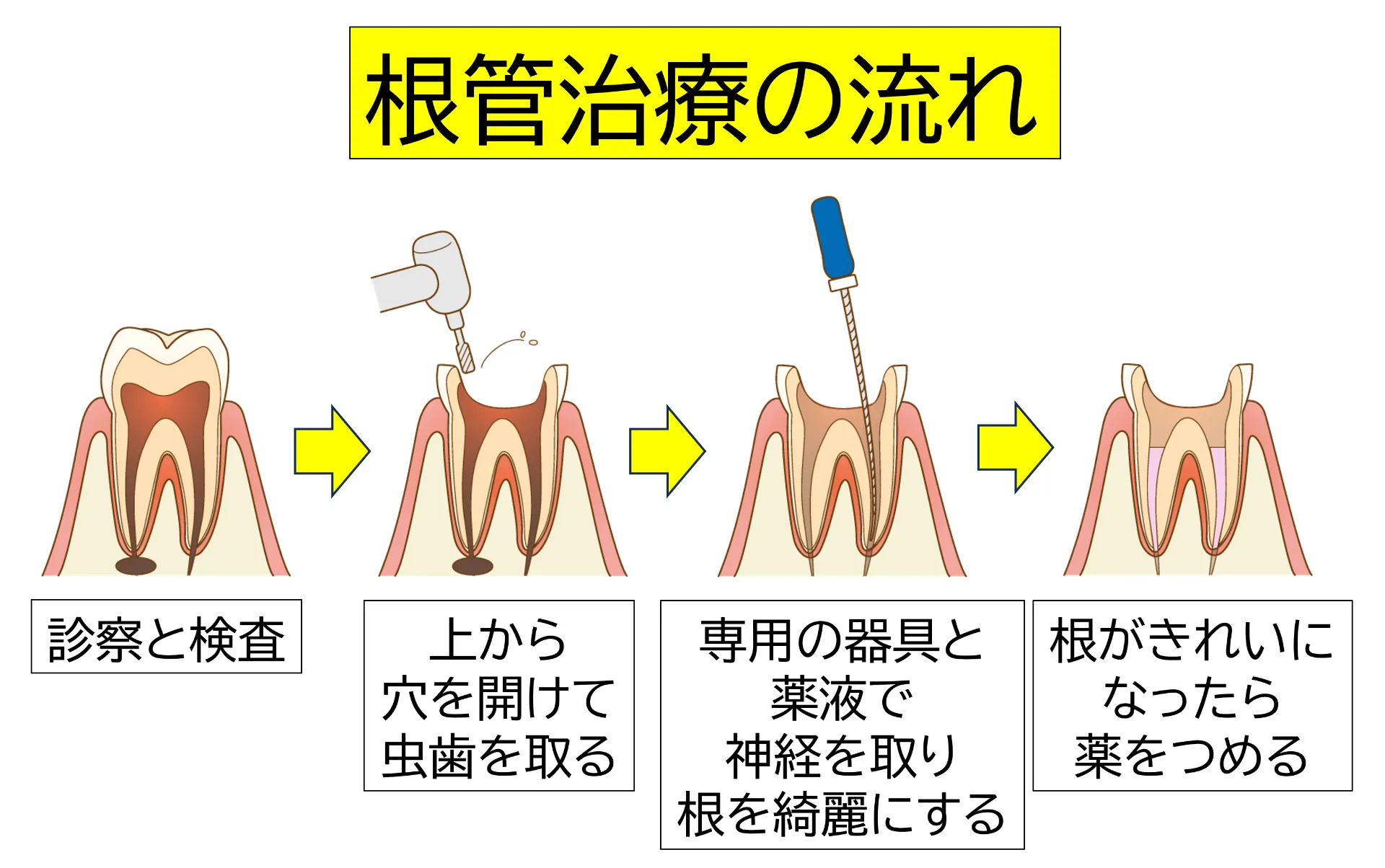 根管治療の流れ図解。診察と検査、虫歯を取る、神経を取り根を清潔にする、薬を詰める、の4ステップ