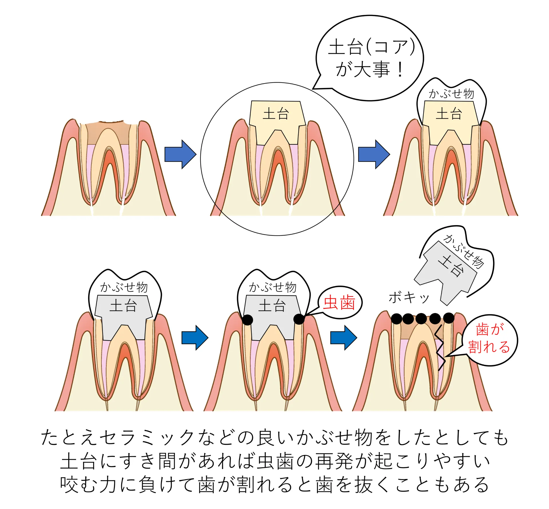 土台にすき間があると虫歯が再発し、歯が割れて抜くことになる場合もあることを示す図解