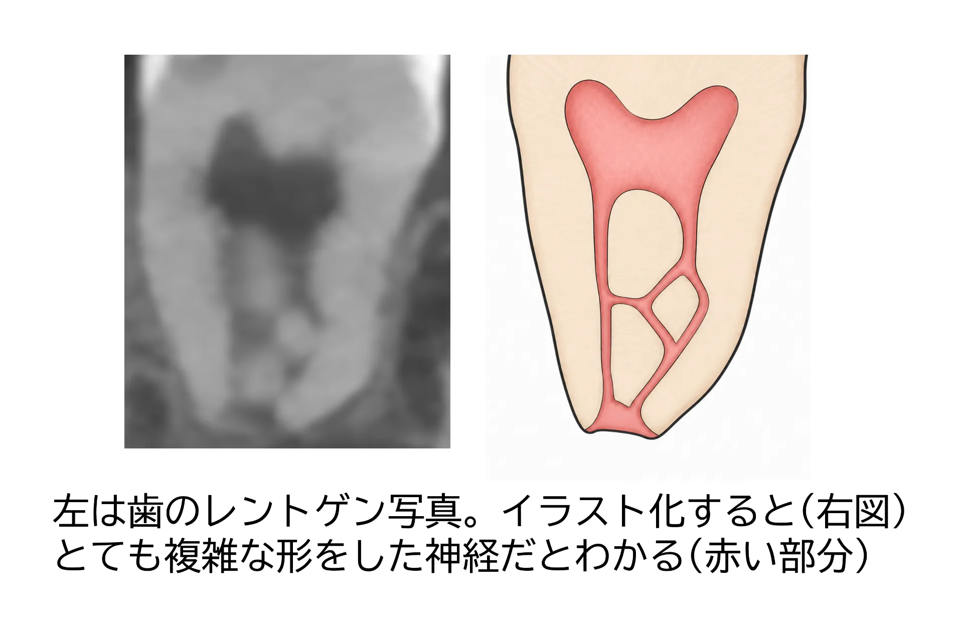 歯のレントゲン写真とイラスト。とても複雑な形をした神経がわかる