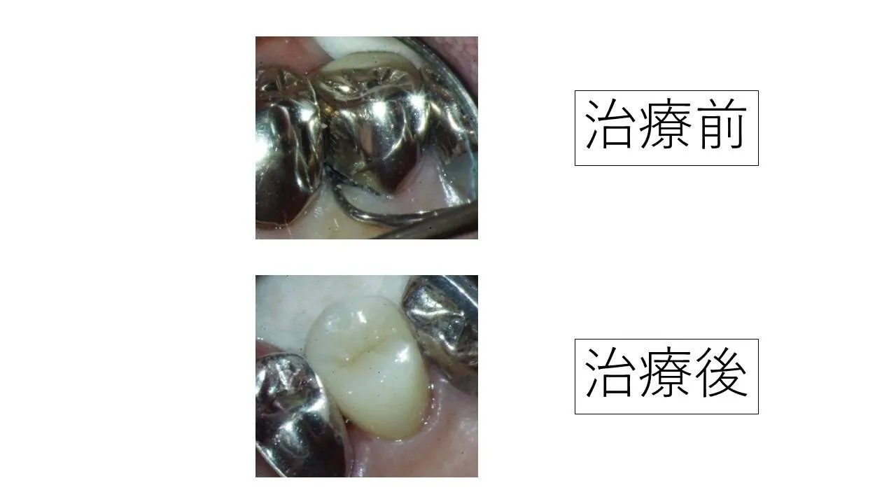 治療前は銀歯、治療後はセラミックのかぶせ物になった歯の写真