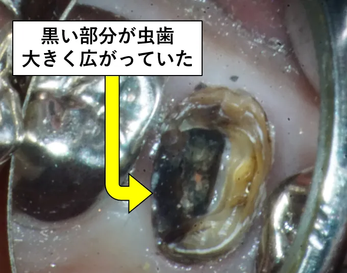 銀歯を外すと内部に大きな虫歯が見つかった写真