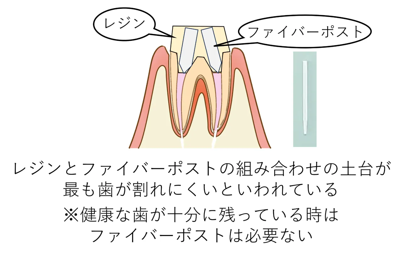 レジンとファイバーポストを組み合わせた土台の図解