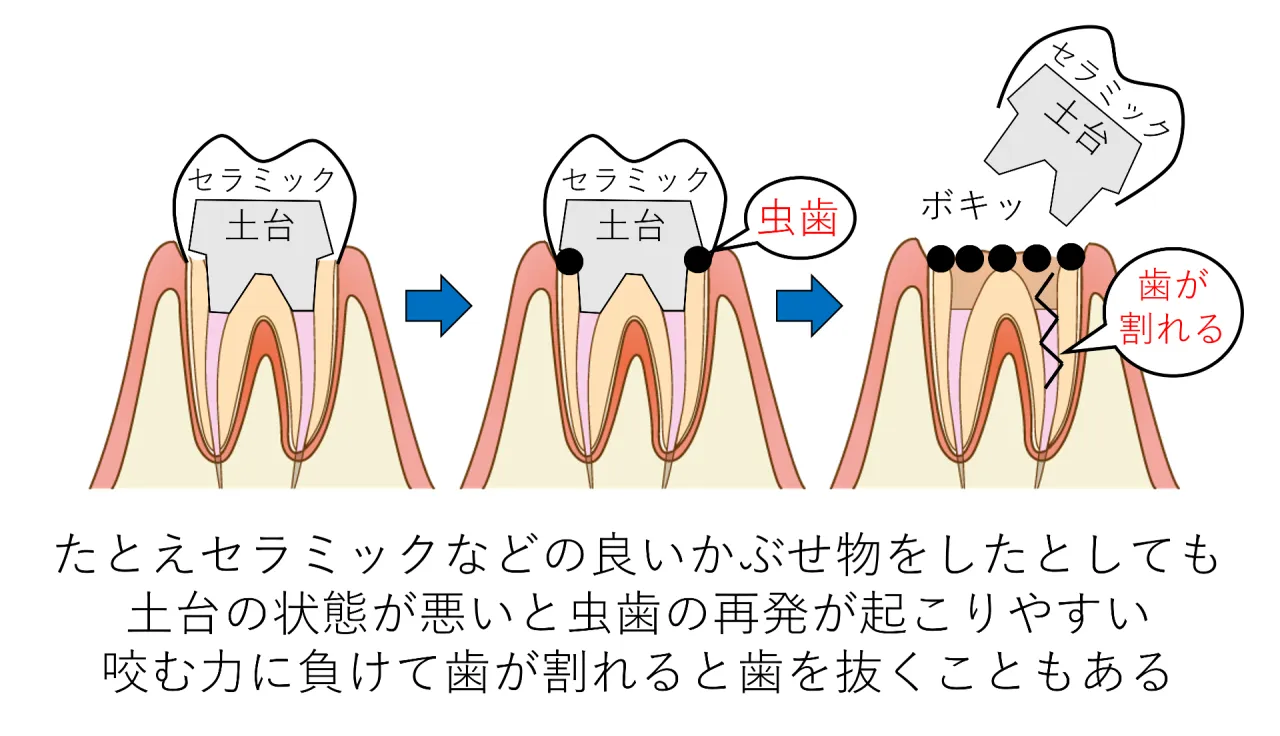 土台の状態が悪いと虫歯が再発しやすく、咬む力に負けて歯が割れると歯を抜くこともあることを示す図解