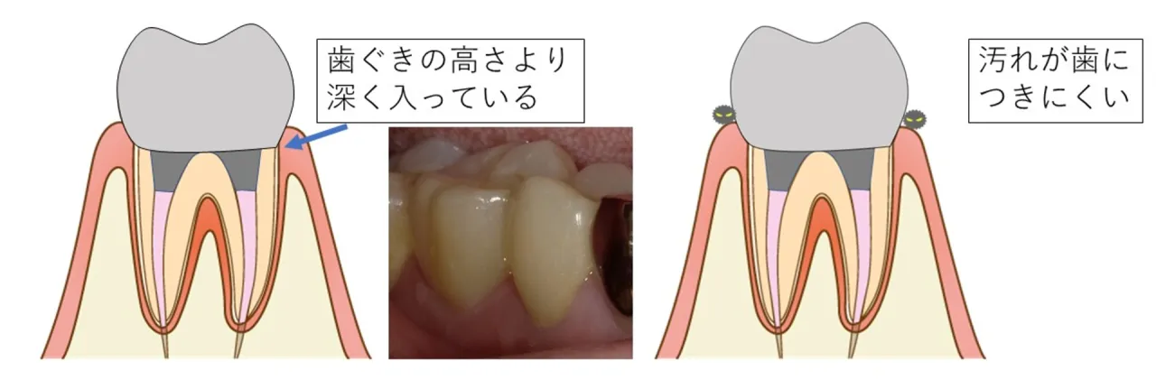 歯ぐきの高さより深く削ることで、汚れが歯につきにくくなることを示す図解