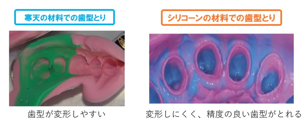 寒天の材料での歯型とりは変形しやすく、シリコーンの材料での歯型とりは変形しにくく精度の良い歯型がとれることを示す比較写真