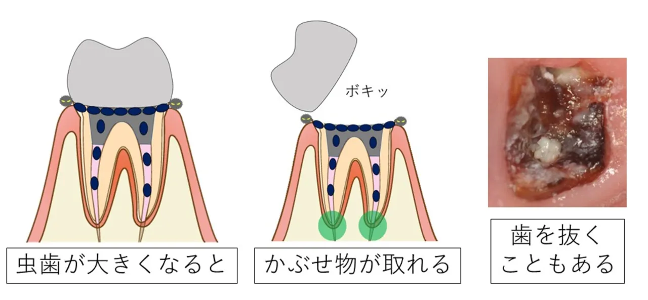 虫歯が大きくなるとかぶせ物が取れ、歯を抜くこともあることを示す図解