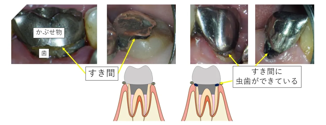 かぶせ物と歯の間にすき間があると、そこに虫歯ができることを示す図解