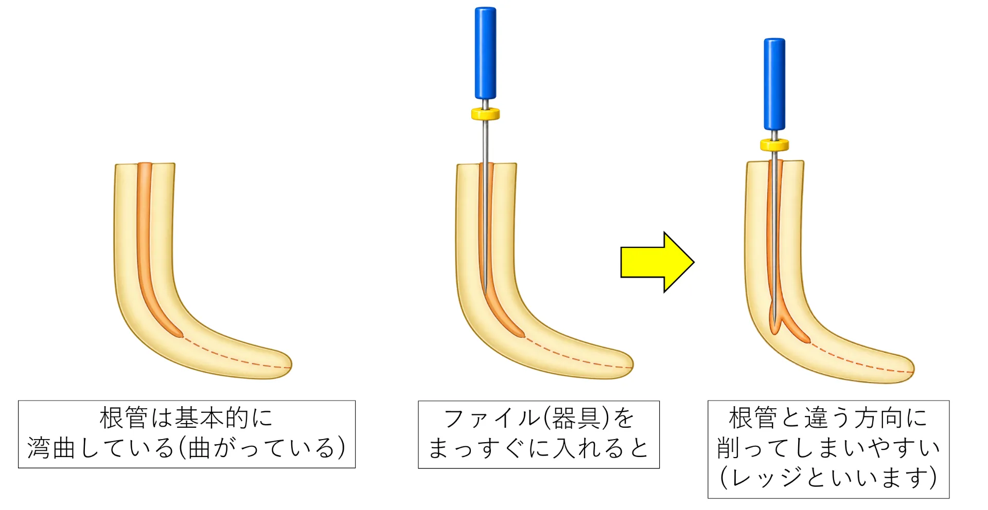 湾曲した根管にまっすぐなファイルを入れるとレッジができる仕組みの図解