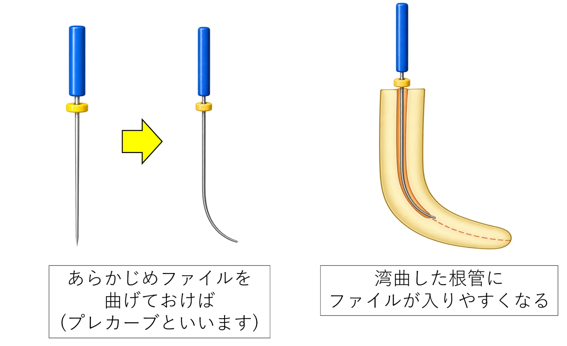 ファイルをあらかじめ曲げておくプレカーブの図解