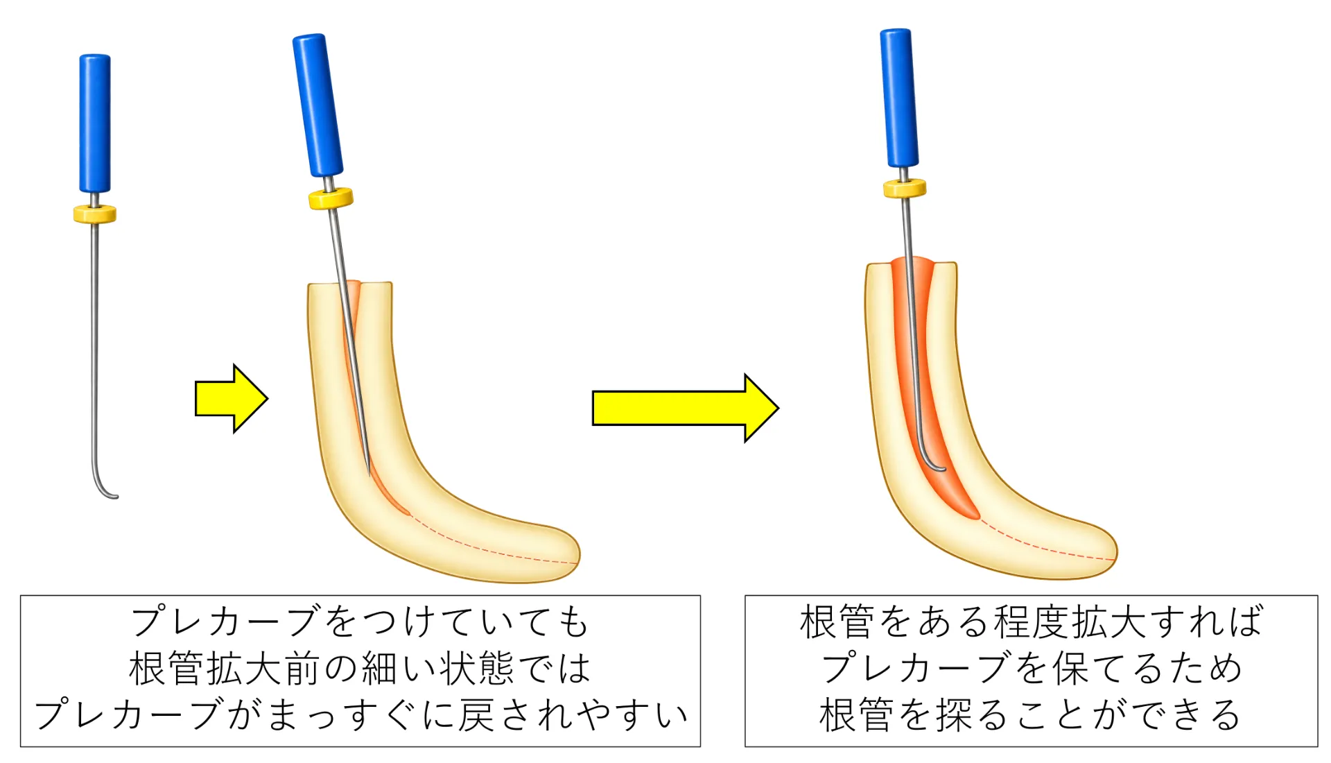根管を拡大していないとプレカーブが効果を発揮しにくいことの図解