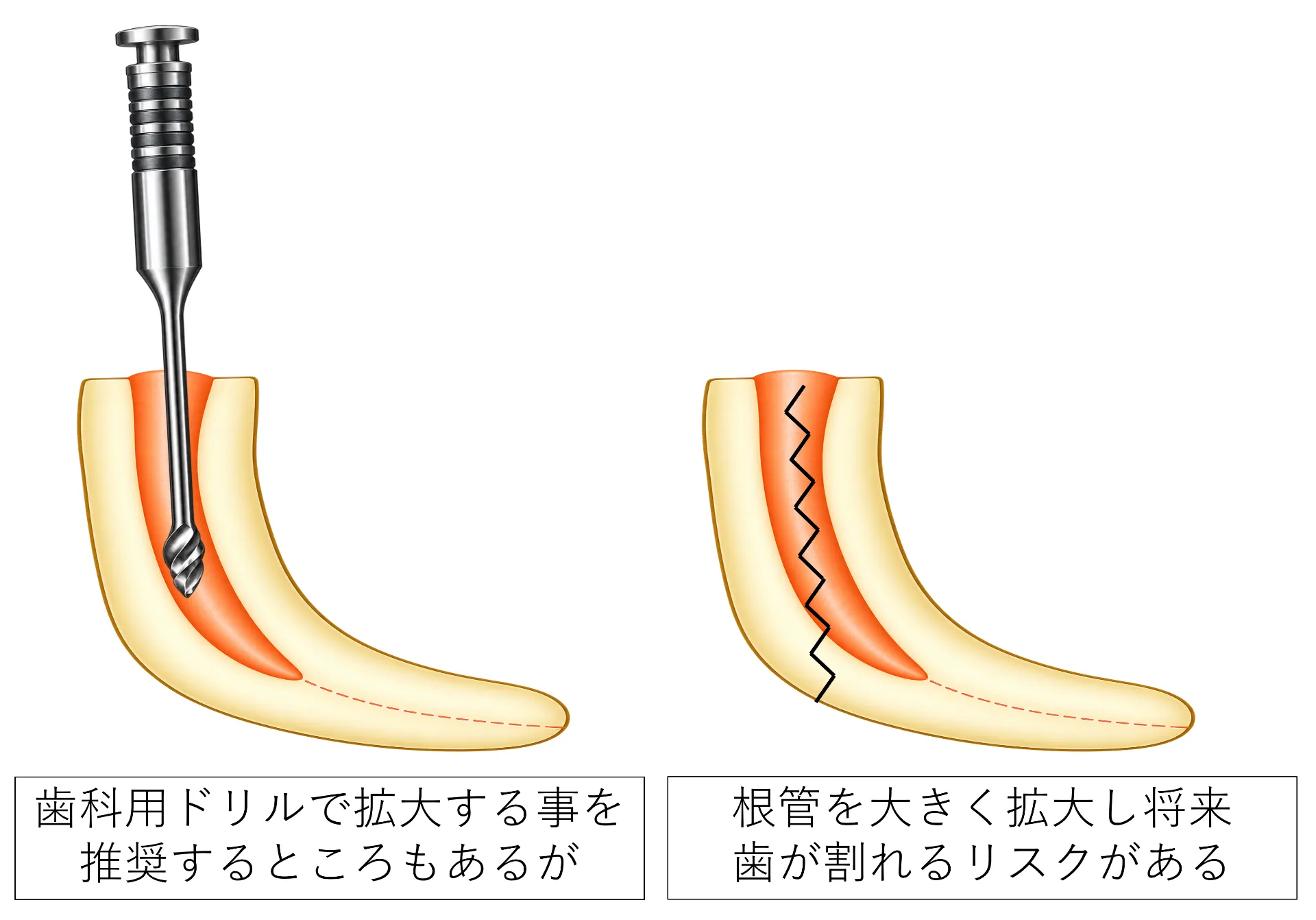 ゲーツドリルによる拡大が歯根破折のリスクを高める可能性があることの図解