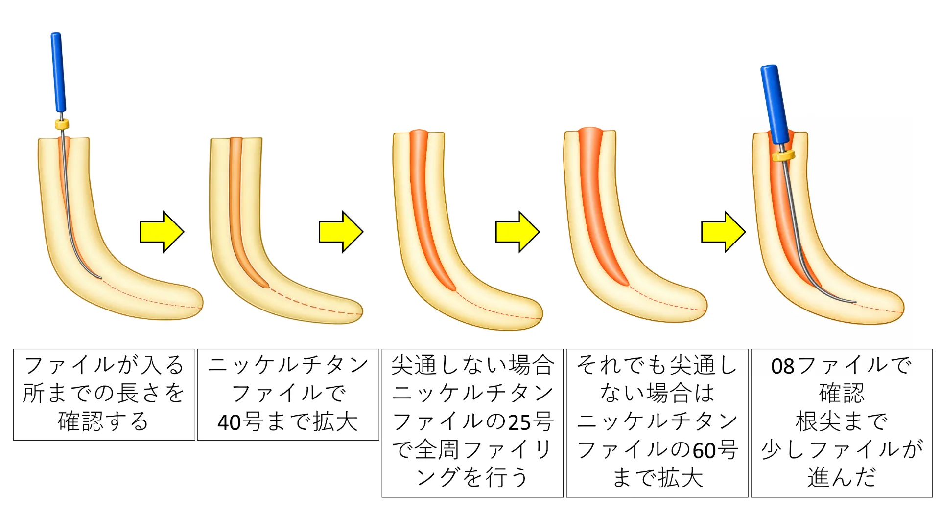 尖通の進め方の図解1。作業長の確認から40号拡大、25号での全周ファイリング、60号までの拡大、08ファイルによる確認までの流れ