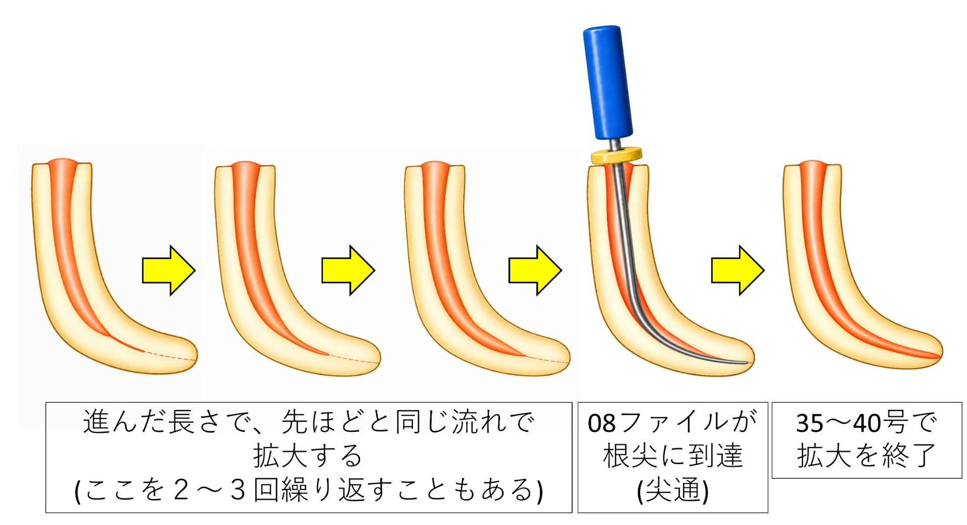 尖通の進め方の図解2。作業長が伸びた場合は同じ流れを繰り返し、08ファイルが根尖に到達(尖通)したら35〜40号まで拡大して終了