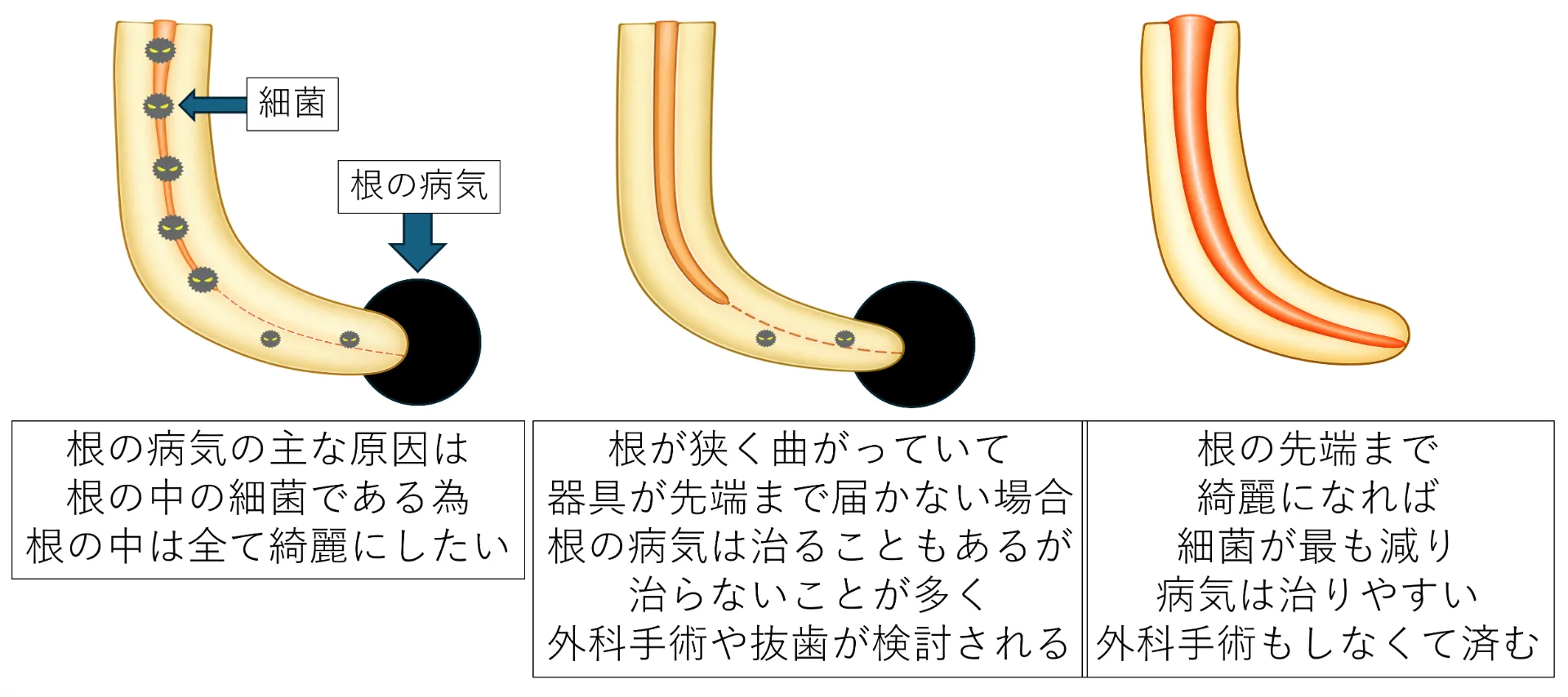 根の病気の主な原因は根の中の細菌であること、根が狭く曲がっていて器具が先端まで届かない場合は病気が治らないことが多く外科手術や抜歯が検討されること、根の先端まで綺麗になれば細菌が最も減り病気が治りやすく外科手術もしなくて済むことを示した図解