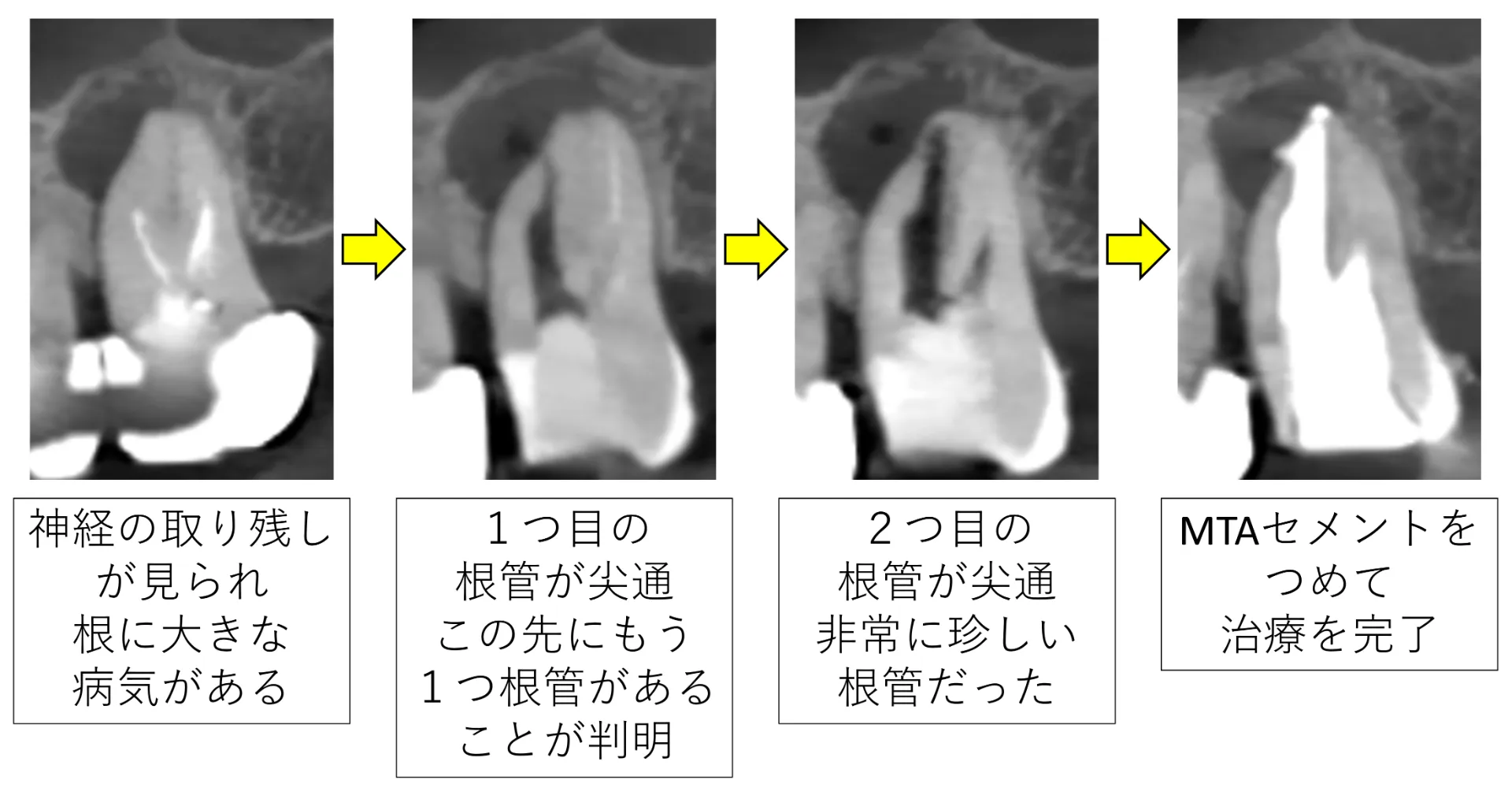 ハーミクス根管治療法による尖通の経過。神経の取り残しによる根尖病変から、1つ目・2つ目の根管の尖通、MTAセメントによる根管充填までのCT画像