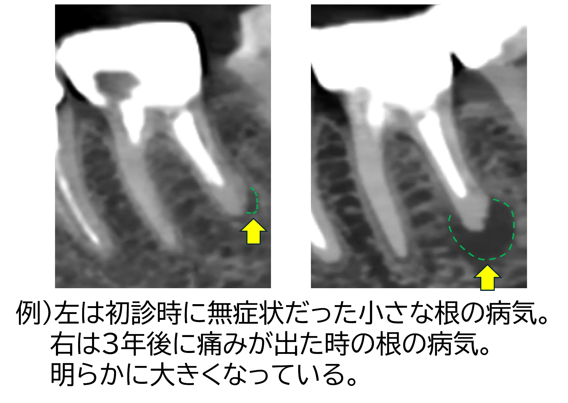 根の病気の進行を示すレントゲン比較。初診時は小さかった根の病気が、3年後には大きくなっている