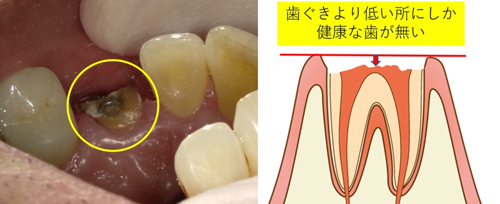 その歯は本当に抜かないといけないのでしょうか？