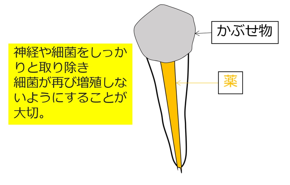 最初(１回目)の治療が大事！しっかりと行う、歯の神経を取る治療(根の治療)について