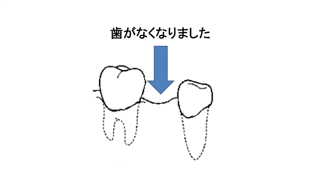 歯が抜けてしまったところをおぎなう治療について。４つ説明します