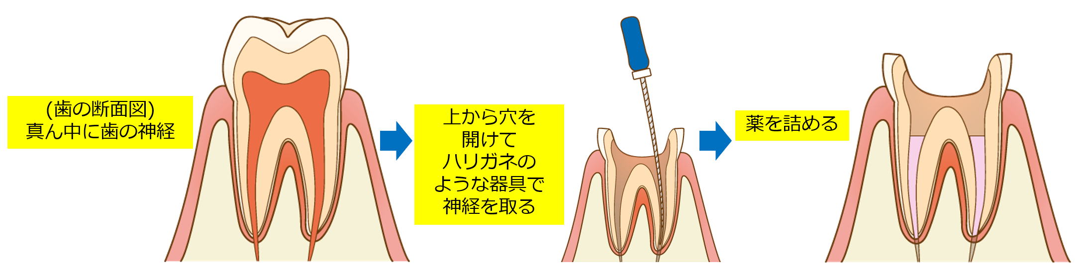 あなたの歯医者は神経を取る理由が明確ですか？