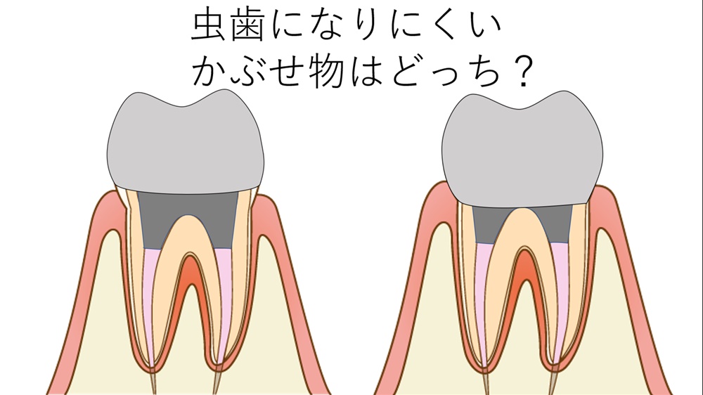 かぶせ物が虫歯になりにくく、長持ちする“削り方”について